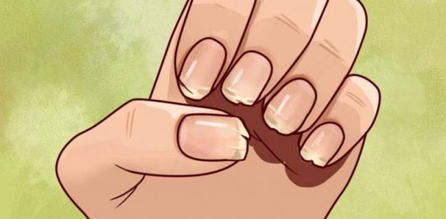 Почему слоятся ногти на руках: причины и лечение в домашних условиях