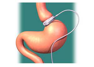 Недостаточность кардии желудка