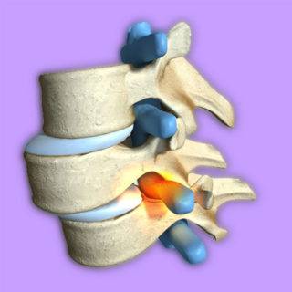 Спондилолистз смещение позвонков пояснично-крестцового отдела позвоночника симптомы