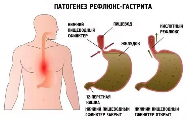 Дуоденогастральный рефлюкс: симптомы, лечение