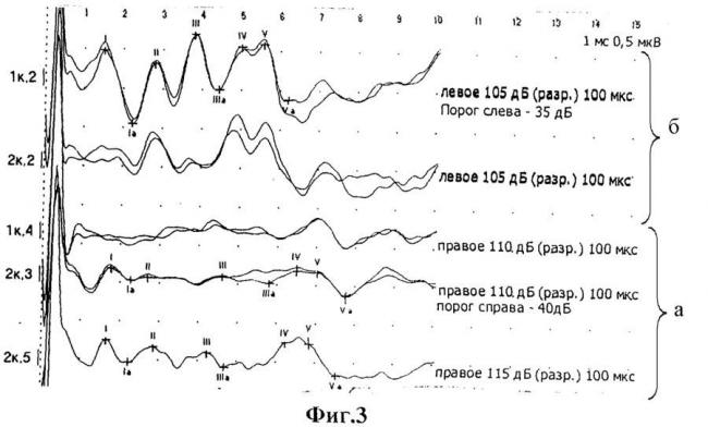 Можно ли вылечить кохлеарный неврит