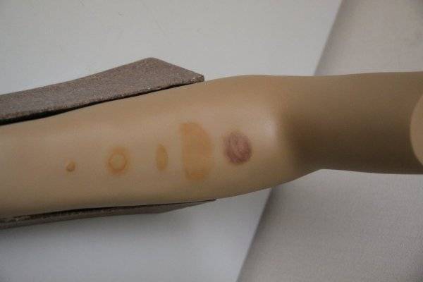 Аллергия на реакцию манту