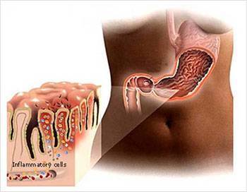 Хеликобактер пилори. симптомы, как передается, схема лечения, лекарства, народные средства, анализы