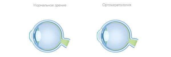 Линзы дышащие - какие самые лучшие для чувствительных глаз