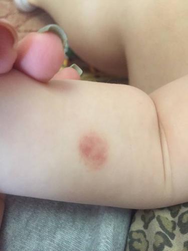 Аллергия на манту у детей и взрослых: причины, симптомы и лечение