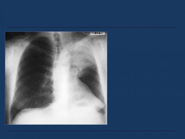 Ателектаз легких у новорожденных