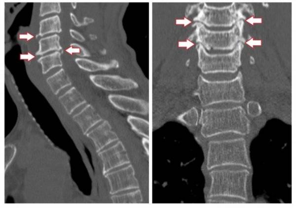 Спондилолистз смещение позвонков пояснично-крестцового отдела позвоночника симптомы
