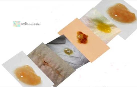 Причины отхаркивания мокроты с кровью