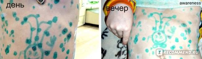 Циндол при ветрянке у детей: показания и инструкция