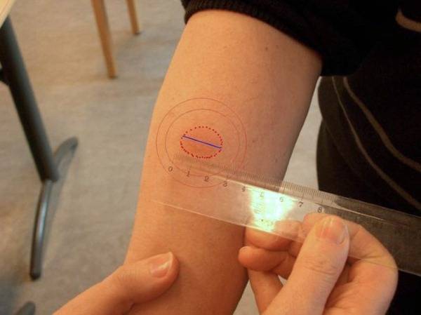 Манту и диаскинтест: что нужно знать родителям