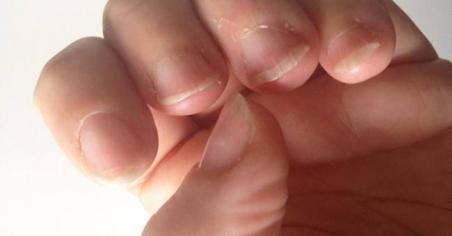 Слоятся ногти на руках – причины, что делать, когда сильно слоятся ногти на руках, лечение