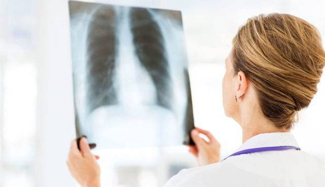 Прикорневая пневмония у взрослых