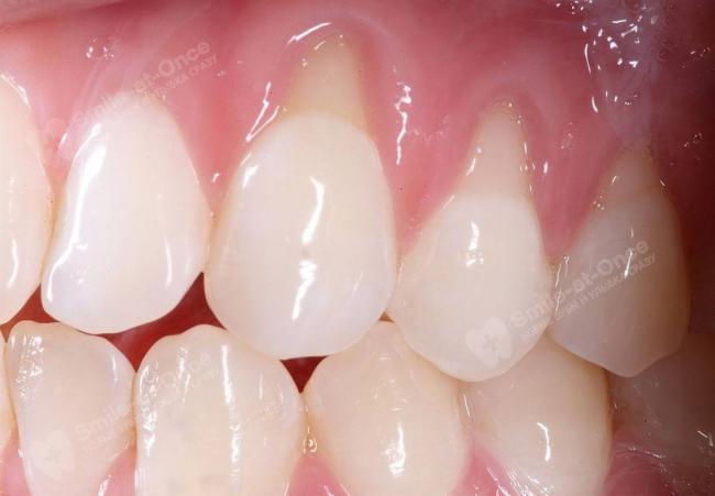 Почему лечение от хеликобактера вредно для здоровья - часть 2