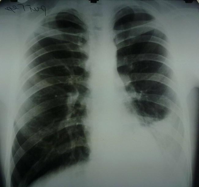 Ателектаз легких у детей