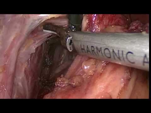 Несмыкание кардии желудка народное лечение