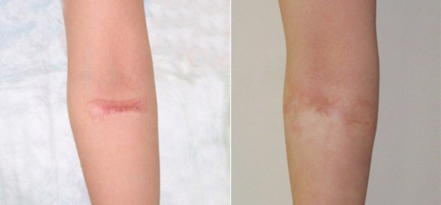 Дерматикс (мазь, гель)