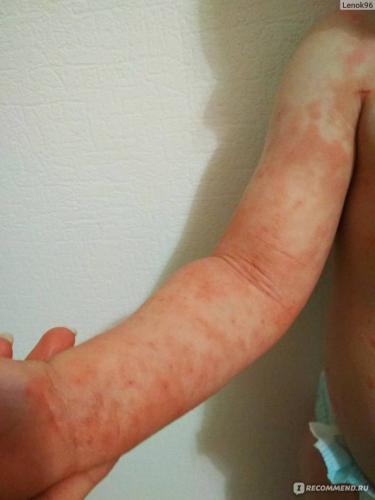 Может ли быть после манту температура