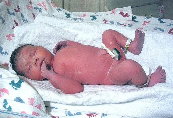 Аспирационная пневмония у новорожденных: какие последствия