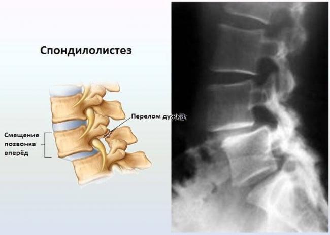 Спондилолистез
