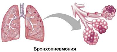 Чем отличается пневмония от воспаления легких