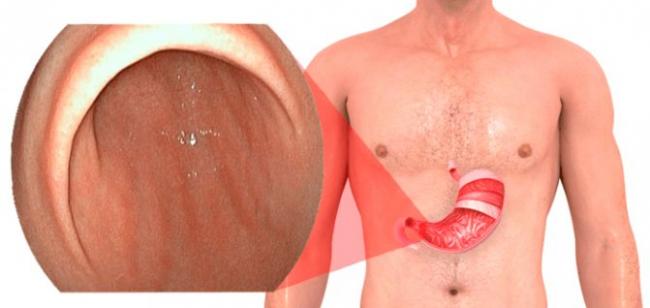 Недостаточность кардии — что это такое? симптомы и лечение заболевания желудка