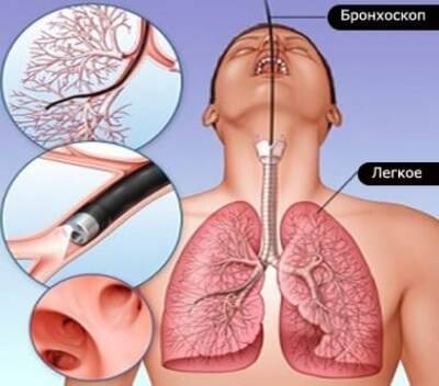 Аспирационная пневмония у новорожденных: какие последствия