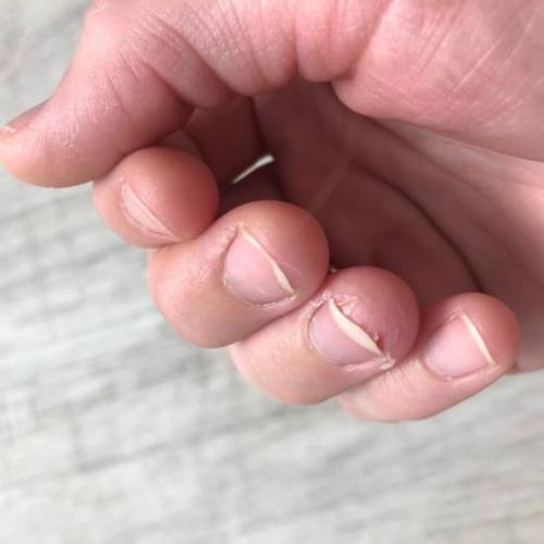 Почему истончаются ногти и что делать в таких случаях