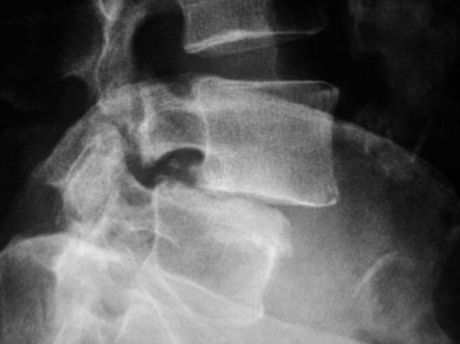 Листезы (смещение позвонков)