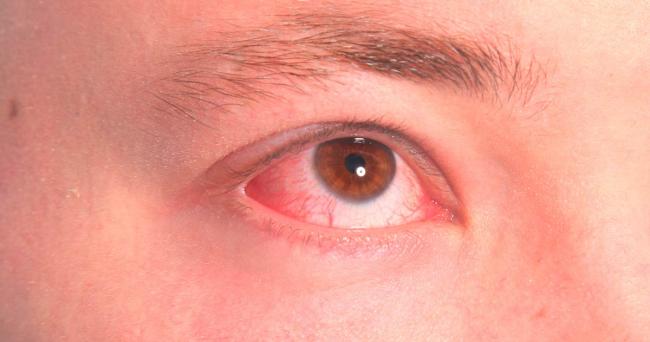 Лечение вирусного конъюнктивита без всяких осложнений