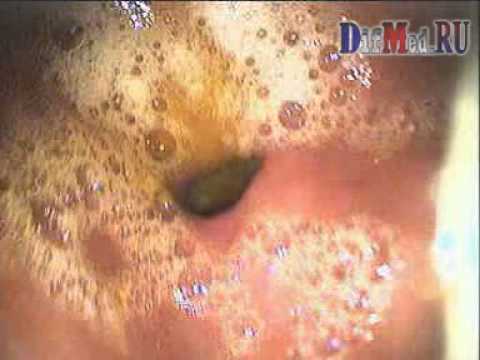 Лечение дуодено-гастрального рефлюкса