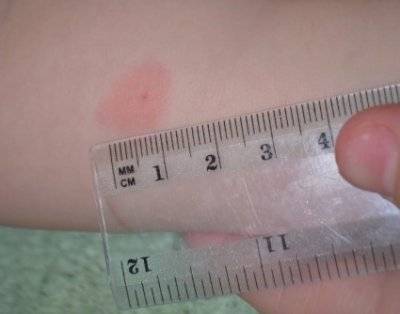 Манту и диаскинтест: что нужно знать родителям