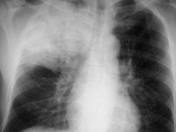 Ателектаз – описание, причины, симптомы, прогноз, лечение