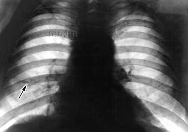 Ателектаз легкого: что это у взрослого, симптомы, лечение, рентген