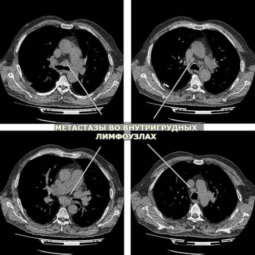 Уточнение диагноза по кт грудной клетки?