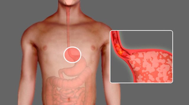 Недостаточность кардии желудка - что это такое и как лечить народными средствами, диетой и лекарствами