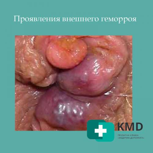 Геморрой – причины, о которых важно знать