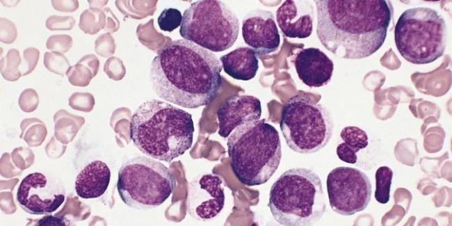 Эозинофилия: понятие, причины и формы, проявления, принципы терапии