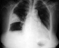 Ателектаз легких у детей | здоровье ребёнка