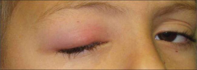 Бактериальный конъюнктивит глаз лечение у взрослых капли