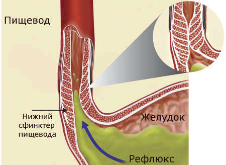 Симптомы заболевания и лечение недостаточности кардии желудка