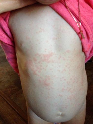 Аллергия на пробу манту