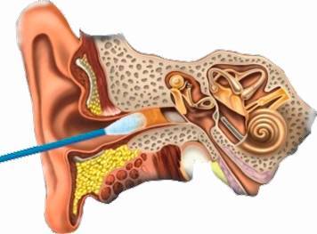 Серные пробки у детей: как убрать их и правильно почистить уши ребенку