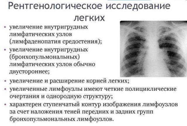 Симптомы и методы лечения прикорневой пневмонии у детей