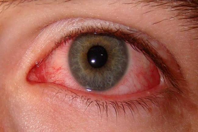 Бактериальный конъюнктивит глаз лечение у взрослых капли