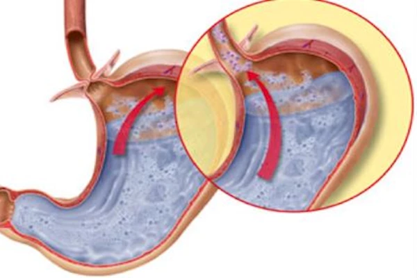 Дуодено-гастральный рефлюкс 1, 2, 3, 4 степени – причины, признаки, лечение, диета. как лечить дуодено-гастральный рефлюкс народными средствами?