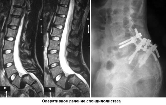 Спондилолистез пояснично-крестцового отдела позвоночника