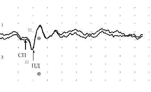 Шум в ухе: причины, лечение