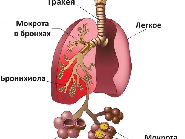 Пневмония у новорожденных и недоношенных детей: симптомы, прогноз, причины, лечение