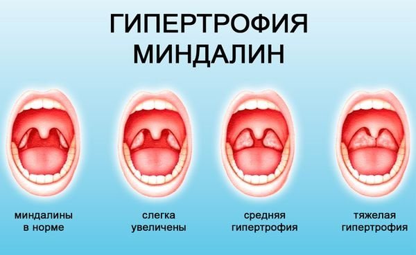 Воспаленные гланды фото у взрослого