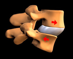 Листезы (смещение позвонков)